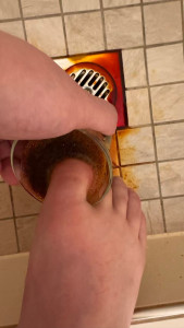 switzerland-toes-infection-169x300 拿了药，泡温水五分钟，酒店没有盆，只能拿杯子，这么搞，不过后来发现有塑料袋。 