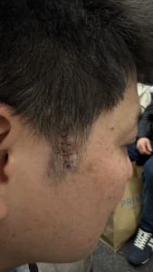 mole-operation-on-cheek-recovery-169x300 一周左右那个创口贴就掉了，拆了之后可以看到缝线，大概三四天的时候会有点痒。一般痒的时候就说明快好了。 