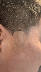 mole-removal-on-right-cheek-by-nhs-2026-03-28-17.32.47-169x300 医生让我两天不要洗澡，说过几天这缝的线会自动的掉。也没给我抗生素，她说伤口很干净，不需要。 
